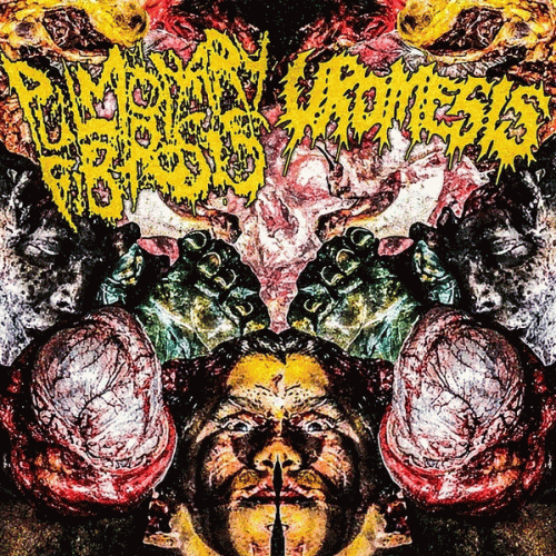 Pulmonary Fibrosis : Pulmonary Fibrosis - Uromesis